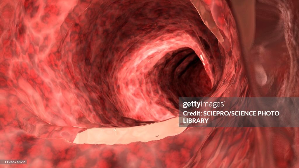 Illustration of an inflamed colon