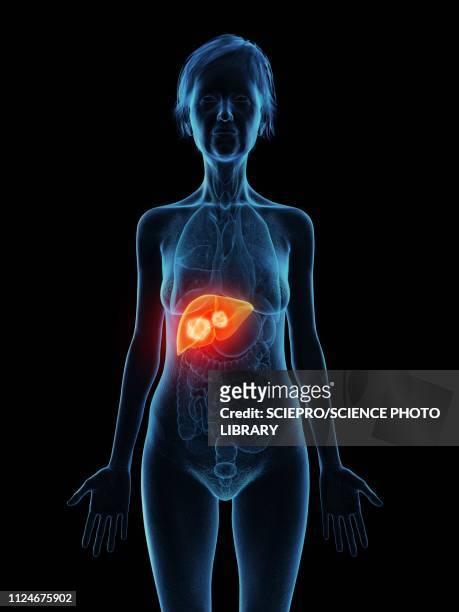 illustration of an old woman's liverticaler tumour - metastatic tumour stock illustrations