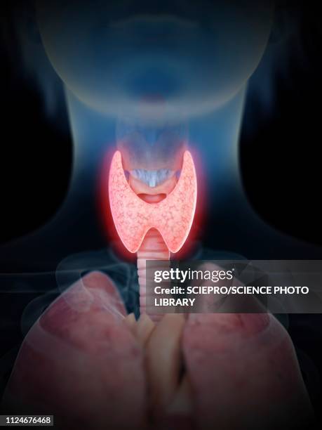 illustration of an inflamed thyroid gland - goiter stock illustrations