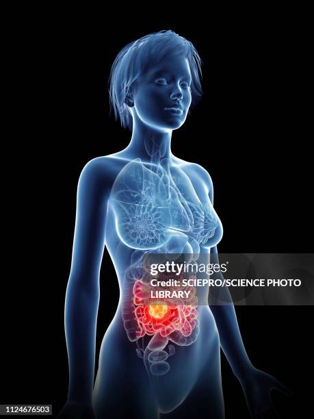 stockillustraties, clipart, cartoons en iconen met illustration of a woman's cancer - darmen