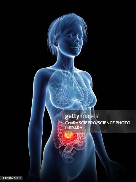 ilustrações, clipart, desenhos animados e ícones de illustration of a woman's cancer - intestino grosso humano