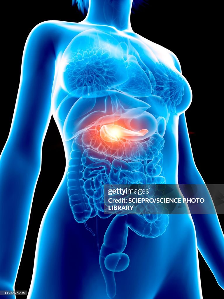 Illustration of a woman's painful pancreas