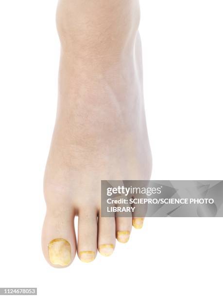 illustration of toe nail fungus - foot fungus stock illustrations