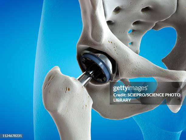 ilustraciones, imágenes clip art, dibujos animados e iconos de stock de illustration of a hip replacement - reemplazo