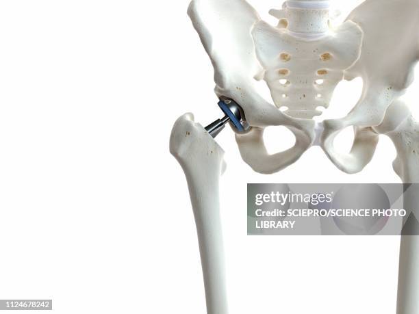 illustration of a hip replacement - hip replacement stock illustrations