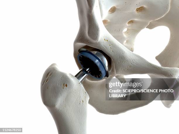 illustration of a hip replacement - femur stock illustrations