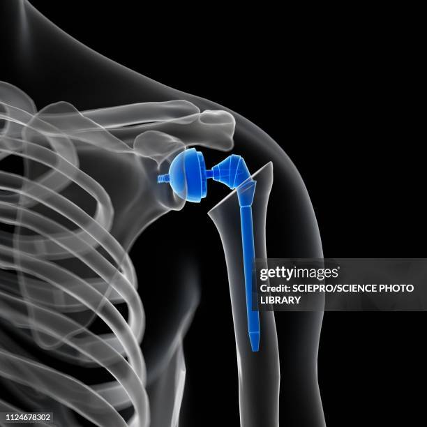 illustration of a shoulder replacement - shoulder stock illustrations