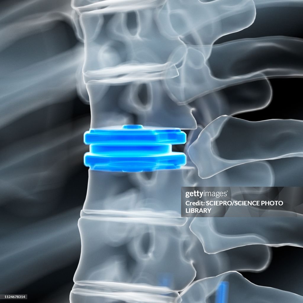 Disc Rework Illustration Of A Disc Replacement High-Res Vector Graphic - Getty Images