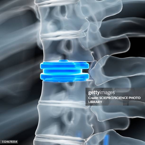 illustration of a disc replacement - spine 幅插畫檔、美工圖案、卡通及圖標