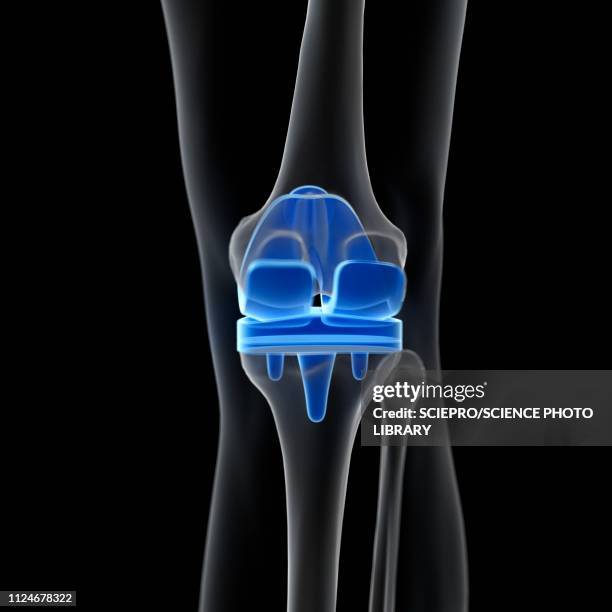 illustrations, cliparts, dessins animés et icônes de illustration of a knee replacement - implant
