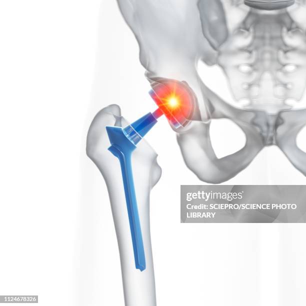 illustration of a hip replacement - hip replacement stock illustrations