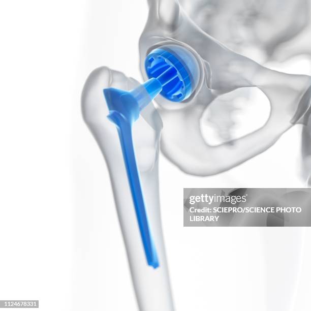 illustration of a hip replacement - prothese stock-grafiken, -clipart, -cartoons und -symbole