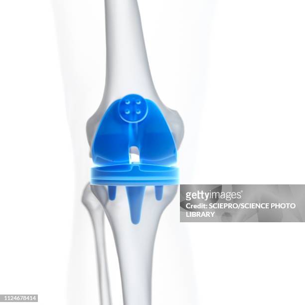 illustration of a knee replacement - knieimplantat stock-grafiken, -clipart, -cartoons und -symbole