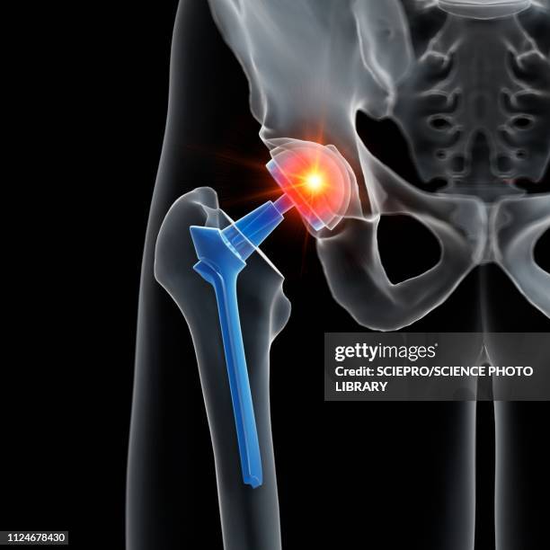 illustration of a hip replacement - künstliches hüftgelenk stock-grafiken, -clipart, -cartoons und -symbole