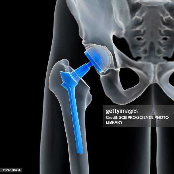 illustration of a hip replacement - hip replacement stock illustrations