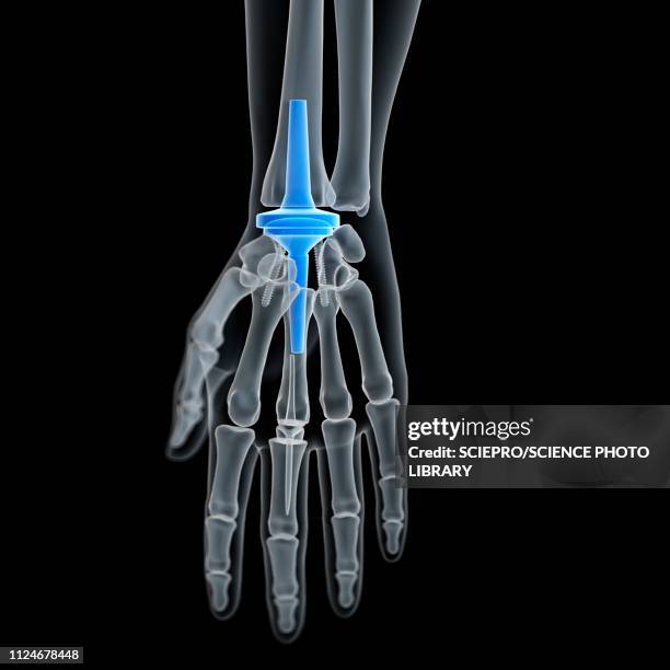 illustration of a wrist replacement - wrist stock illustrations
