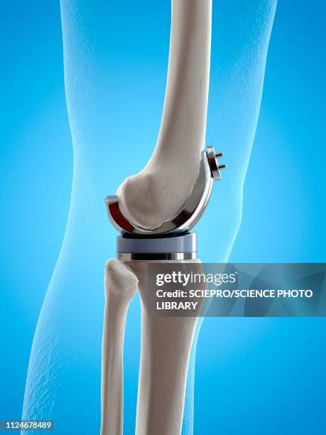 illustrazioni stock, clip art, cartoni animati e icone di tendenza di illustration of a knee replacement - knee replacement surgery