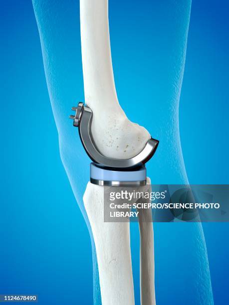 ilustrações, clipart, desenhos animados e ícones de illustration of a knee replacement - knee replacement surgery
