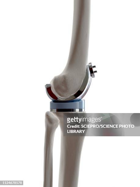 illustration of a knee replacement - knieimplantat stock-grafiken, -clipart, -cartoons und -symbole