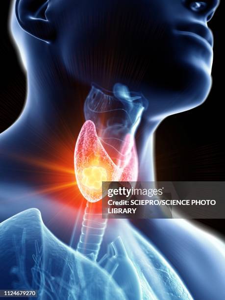 illustration of a man's thyroid gland cancer - goiter stock illustrations