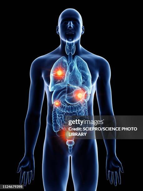 illustrazioni stock, clip art, cartoni animati e icone di tendenza di illustration of a man with metastases - tumore metastatico