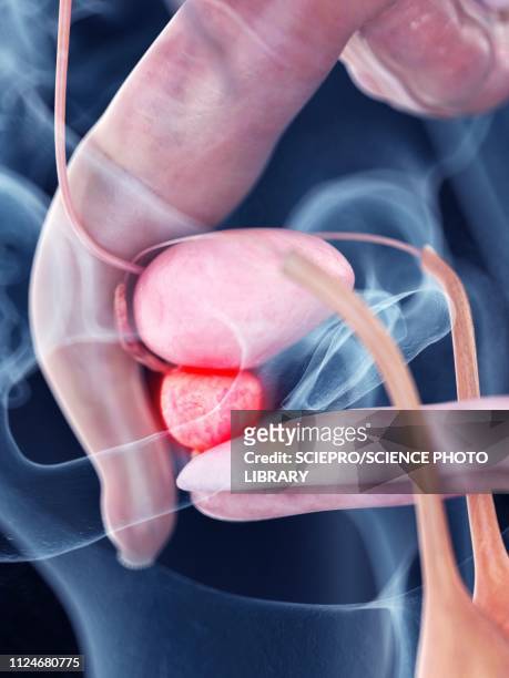 ilustraciones, imágenes clip art, dibujos animados e iconos de stock de illustration of an inflamed pancreas - prostate gland