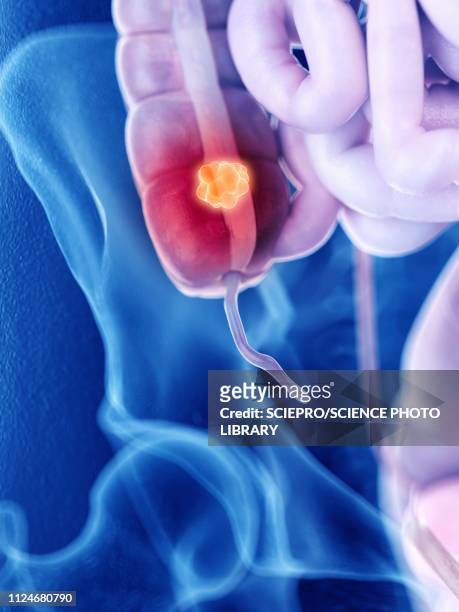 illustration of colon cancer - appendix stock-grafiken, -clipart, -cartoons und -symbole