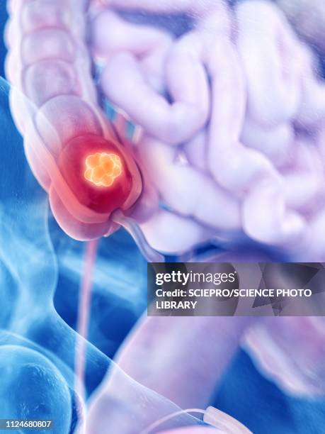illustration of colon cancer - colorectal cancer stock illustrations