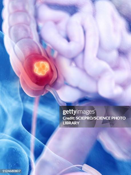 illustration of colon cancer - appendix stock illustrations