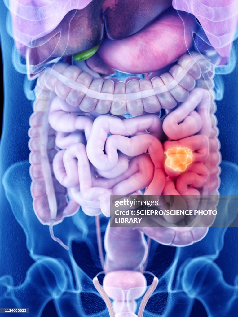 Illustration of intestine cancer