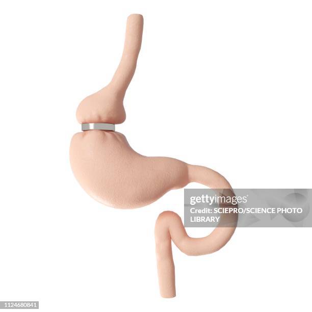 illustration of gastric banding - bariatric stock illustrations