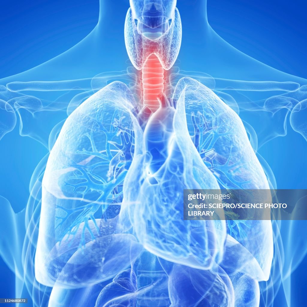 Trachea Dysfunction Illustration Of An Inflamed Trachea Illustration - Getty Images