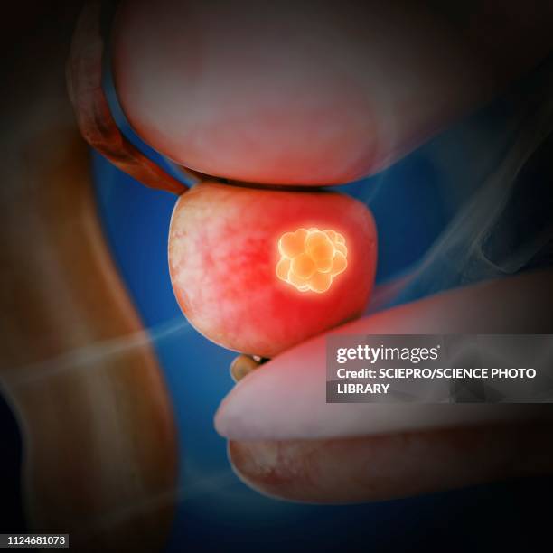 Prostatic Metastasis Metastatic Prostate Cancer Photos and Premium High Res Pictures - Getty ...