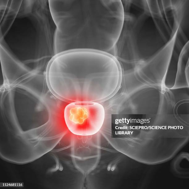 illustration of prostate cancer - prostata stock-grafiken, -clipart, -cartoons und -symbole