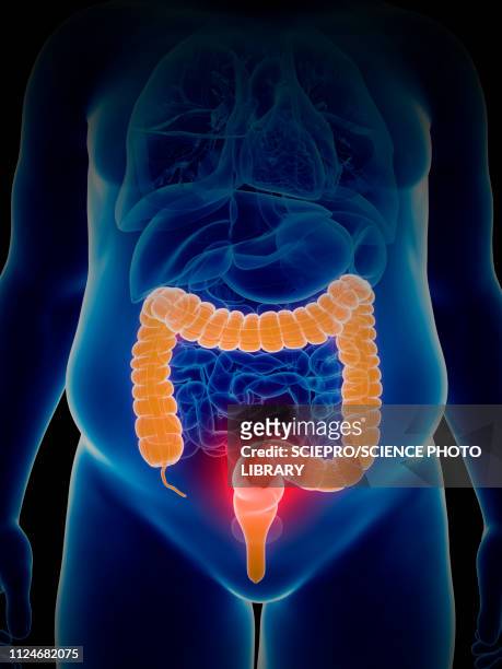 illustration of colon cancer - human intestine点のイラスト素材／クリップアート素材／マンガ素材／アイコン素材