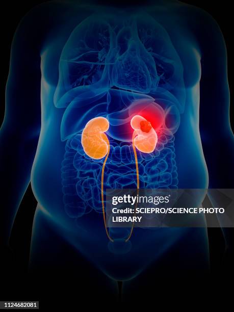 illustration of kidney cancer - metastatic tumour stock-grafiken, -clipart, -cartoons und -symbole