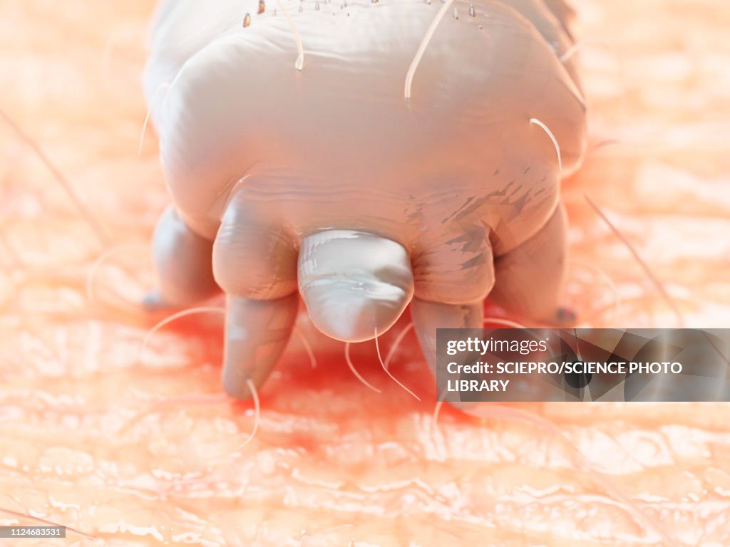 Illustration of a scabies mite on human skin