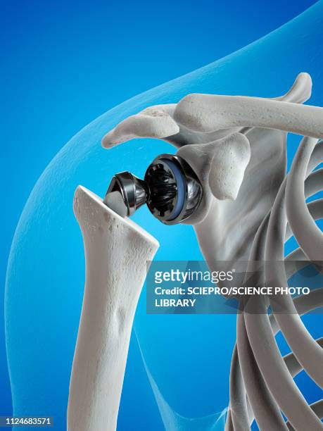 illustration of a shoulder replacement - shoulder bone stock illustrations