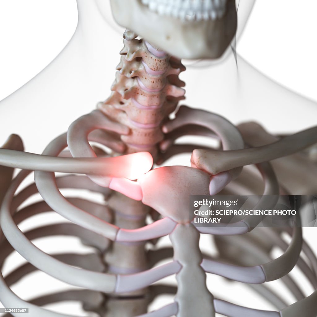 Illustration of painful sternoclaverticalicular joint