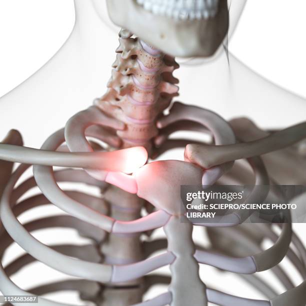 illustration of painful sternoclaverticalicular joint - rheumatism stock illustrations