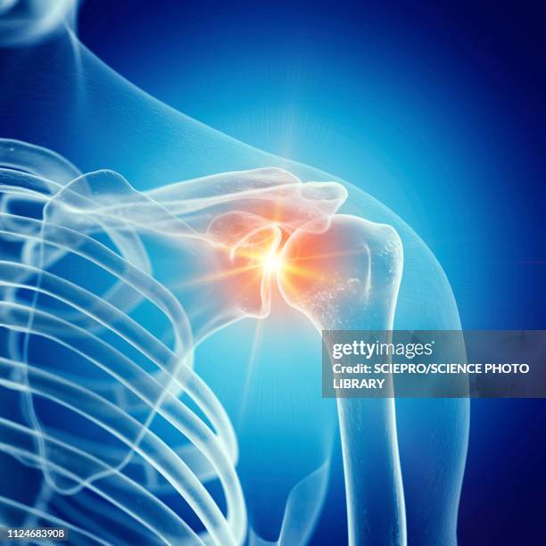 stockillustraties, clipart, cartoons en iconen met illustration of a painful shoulder joint - shoulder joint