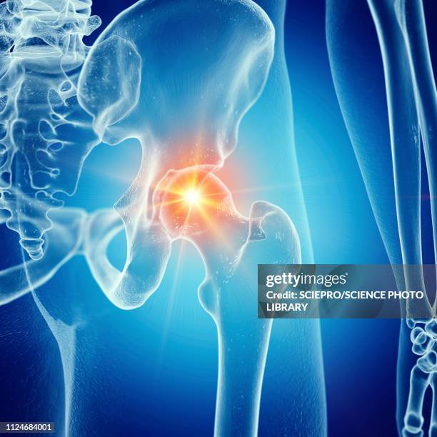 illustration of a painful hip joint - femur stock illustrations