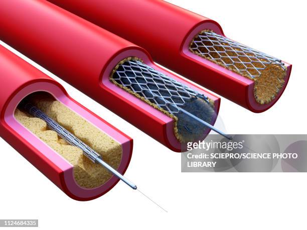 illustration of a stent being placed - balloon catheter stock illustrations