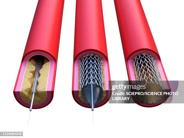 illustration of a stent being placed - stent stock illustrations