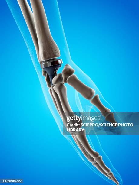 illustration of a wrist replacement - prosthetic equipment stock illustrations