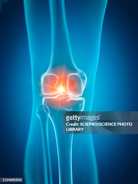 ilustraciones, imágenes clip art, dibujos animados e iconos de stock de illustration of a painful knee - femur