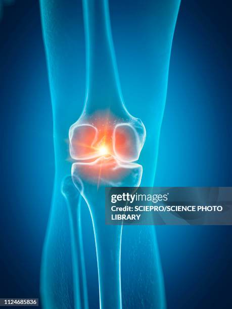 ilustrações, clipart, desenhos animados e ícones de illustration of a painful knee - rótula