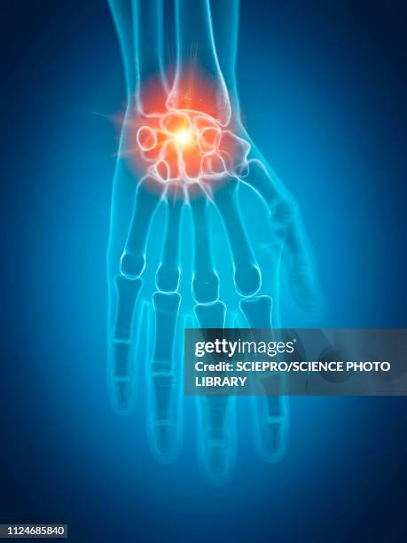 ilustraciones, imágenes clip art, dibujos animados e iconos de stock de illustration of a painful wrist - radio hueso del brazo