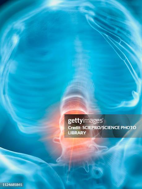 illustration of a painful lower spine - rheuma stock-grafiken, -clipart, -cartoons und -symbole