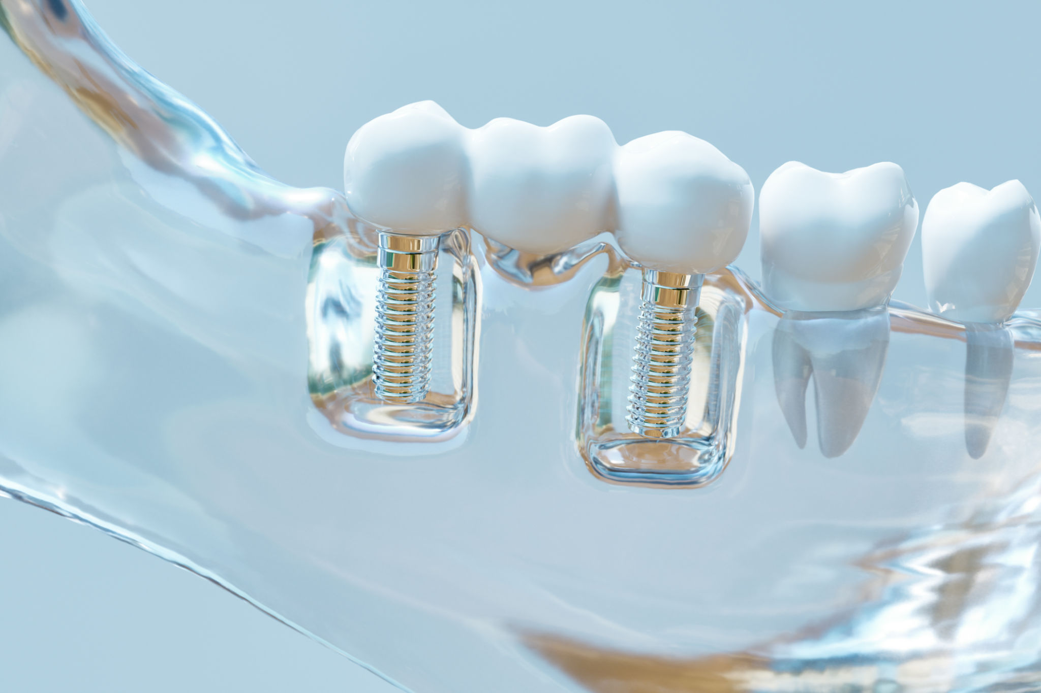 implant dentist